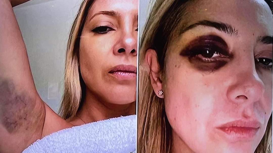 DIFUNDIERON FOTOS DE FABIOLA YAÑEZ GOLPEADA Y LOS CHATS CON ALBERTO FERNÁNDEZ.